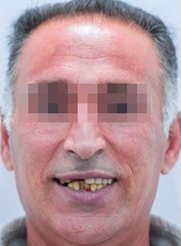 Antes-Impante